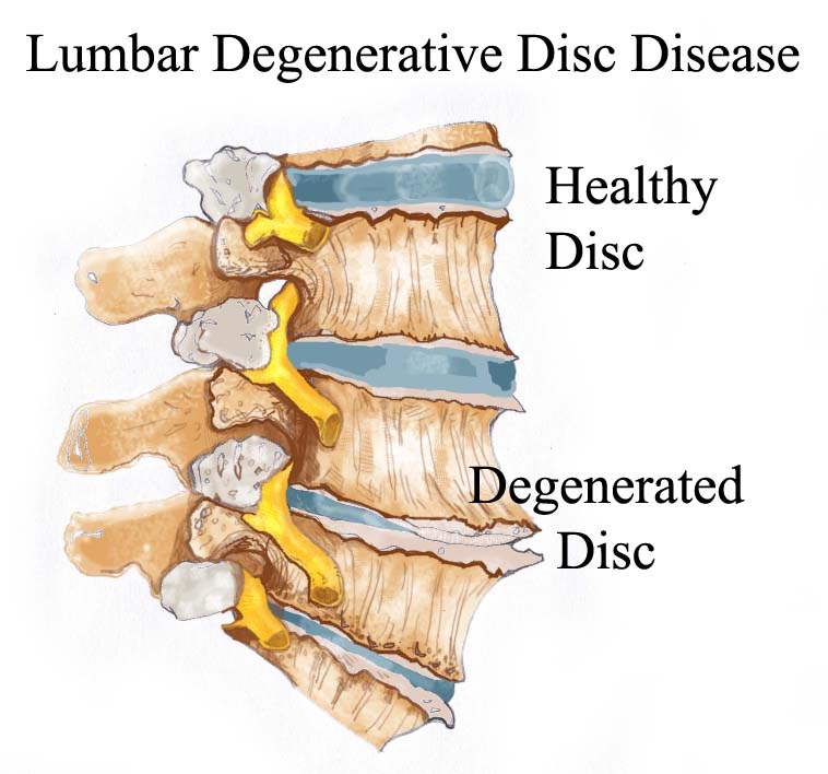 Lumbar-degeneratiive-disc-disease