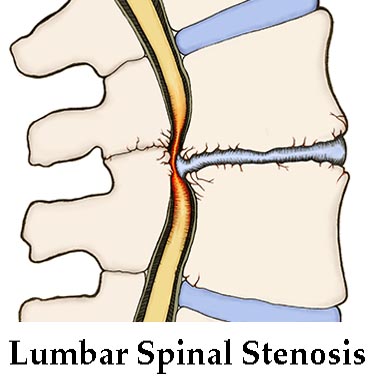 Lumbar-spinal-stenosis 380x380