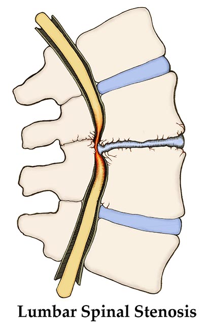 Lumbar-spinal-stenosis 400x640